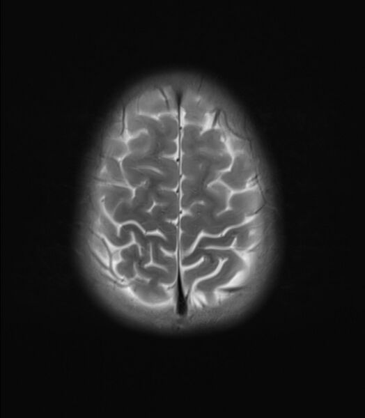 File:Brainstem glioma (Radiopaedia 70548-80674 Axial T2 22).jpg
