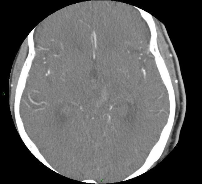 File:Brainstem hemorrhage (Radiopaedia 58794-66028 D 89).jpg