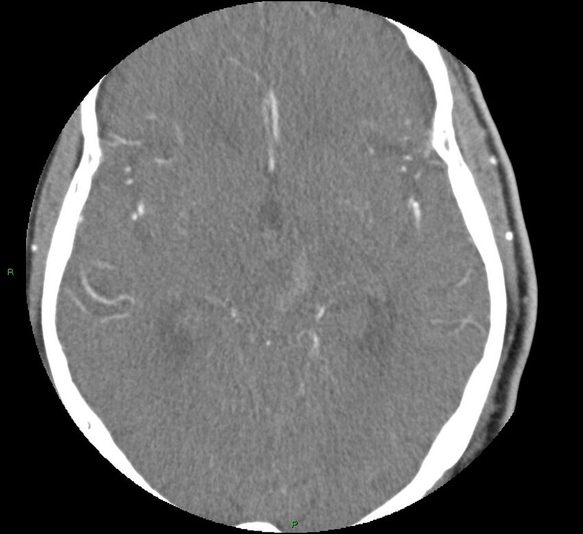 Brainstem hemorrhage (Radiopaedia 58794-66028 D 89).jpg