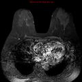 Breast carcinoma (multicentric multifocal in mammary Paget disease) (Radiopaedia 50966-56512 Axial T1 C+ fat sat 6).jpg