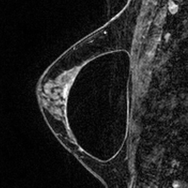 File:Breast implants - MRI (Radiopaedia 26864-27035 Sagittal T2 22).jpg