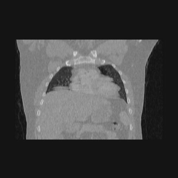 File:Bronchial atresia (Radiopaedia 60685-68439 Coronal lung window 54).jpg