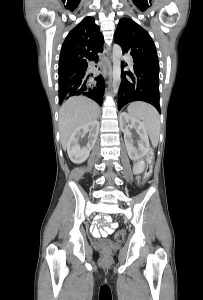 File:Bronchial carcinoid tumor (Radiopaedia 57187-64090 B 78).jpg