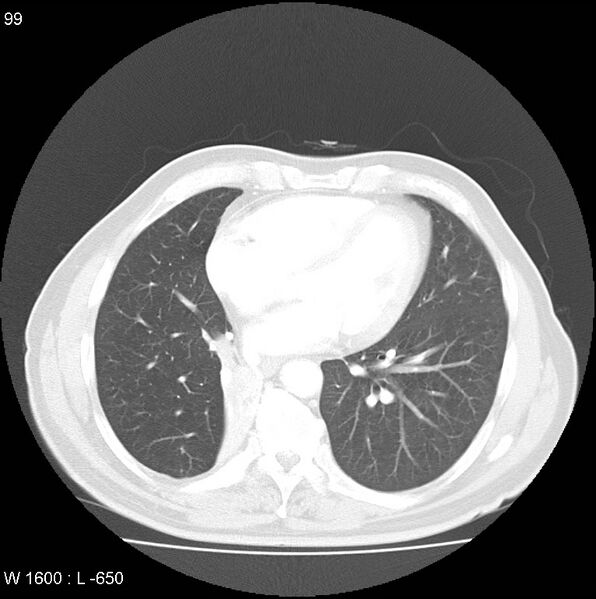 File:Bronchial carcinoid tumor with right lower lobe collapse (Radiopaedia 29060-29422 B 37).jpg