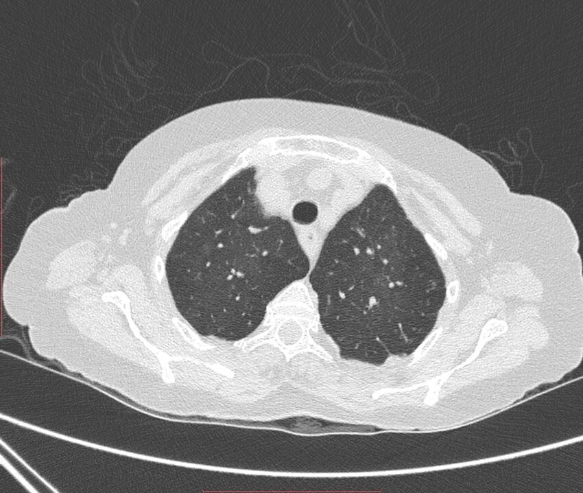 Bronchiectasis (Radiopaedia 72693-83293 Axial lung window 20).jpg