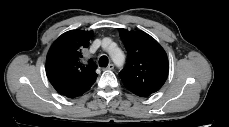 File:Bronchogenic carcinoma with superior vena cava syndrome (Radiopaedia 36497-38054 Axial C+ delayed 23).jpg