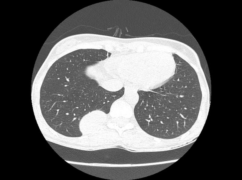 File:Bronchogenic cyst (Radiopaedia 80273-93615 Axial lung window 14).jpg