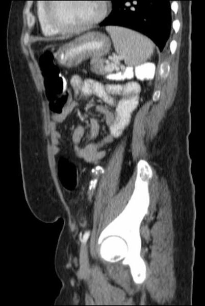 File:Brown tumors compressing the spinal cord (Radiopaedia 68442-77988 F 40).jpg