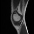 Bucket handle tear - lateral meniscus (Radiopaedia 72124-82634 Sagittal T1 15).jpg