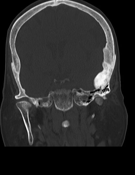 File:Burnt-out meningioma (Radiopaedia 51557-57337 Coronal bone window 25).jpg