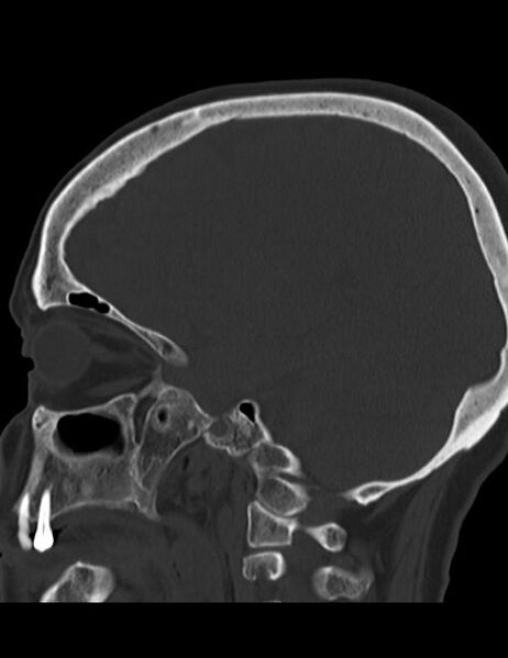 File:Burnt-out meningioma (Radiopaedia 51557-57337 Sagittal bone window 16).jpg