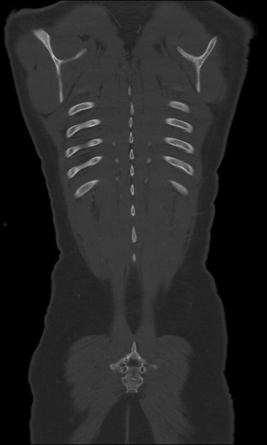 Burst fracture (Radiopaedia 83168-97542 Coronal bone window 65).jpg