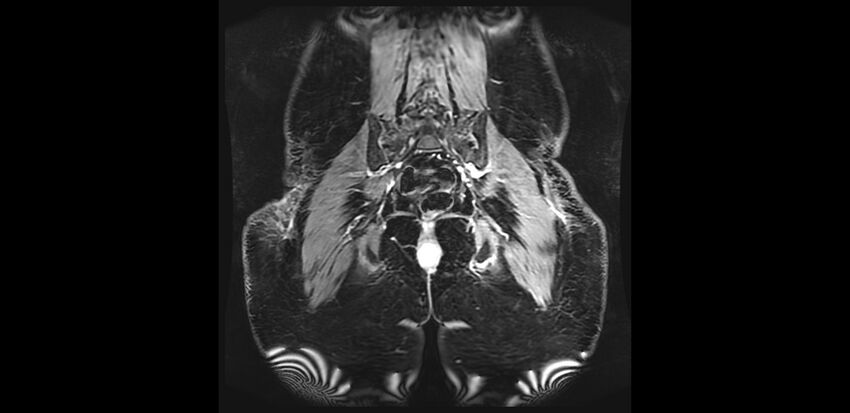 Buttock filler complications (Radiopaedia 63497-72115 Coronal T1 C+ 40).jpg