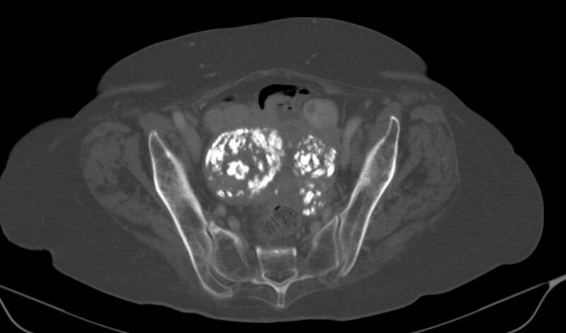 File:Calcified fibroids (Radiopaedia 20306-20228 Axial bone window 16).jpg