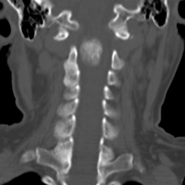 File:Calcified meningioma - cervical canal (Radiopaedia 70136-80171 Coronal bone window 15).jpg