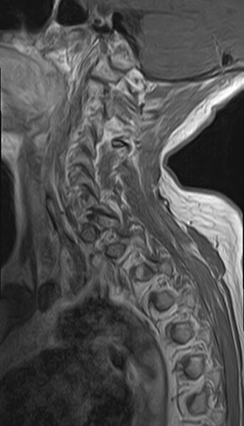 File:Calcified meningioma - cervical canal (Radiopaedia 70136-82468 Sagittal 12).jpg