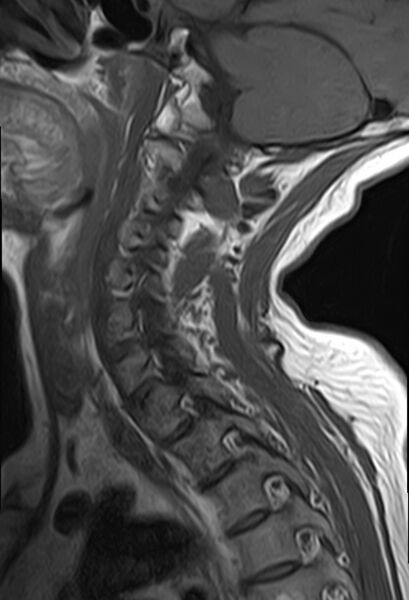 File:Calcified meningioma - cervical canal (Radiopaedia 70136-82468 Sagittal T1 10).jpg