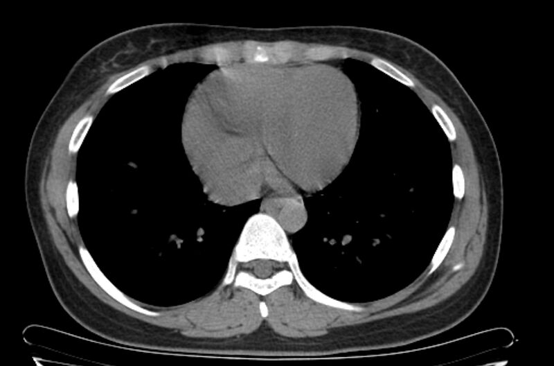 File:Cannonball metastases - uterine choriocarcinoma (Radiopaedia 70137-80173 Axial non-contrast 85).jpg