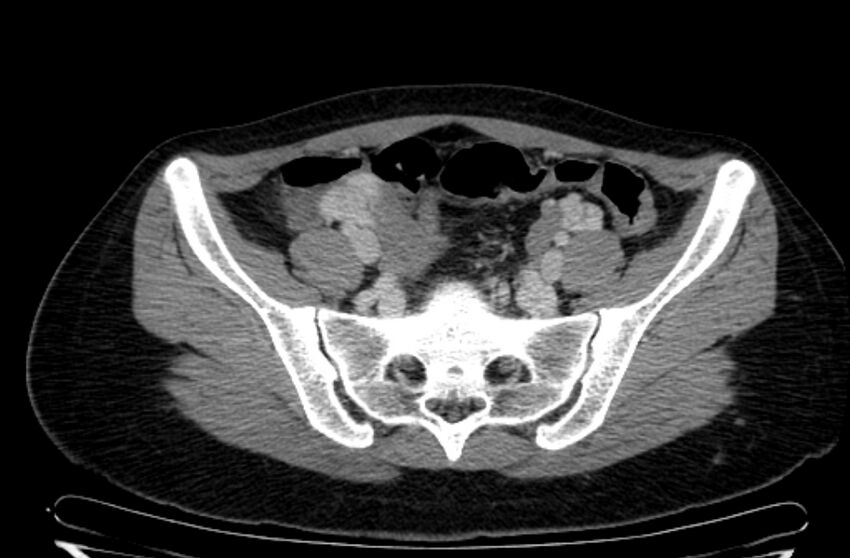 Cannonball metastases - uterine choriocarcinoma (Radiopaedia 70137-80174 A 3).jpg