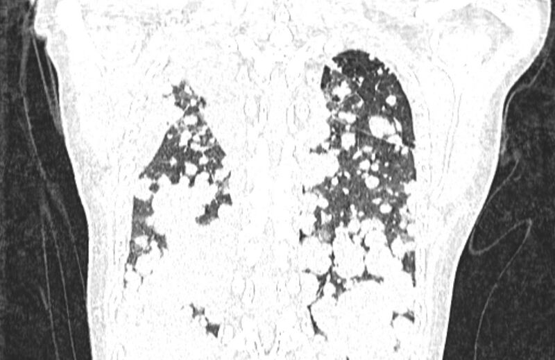 File:Cannonball metastases from breast cancer (Radiopaedia 91024-108569 Coronal lung window 121).jpg