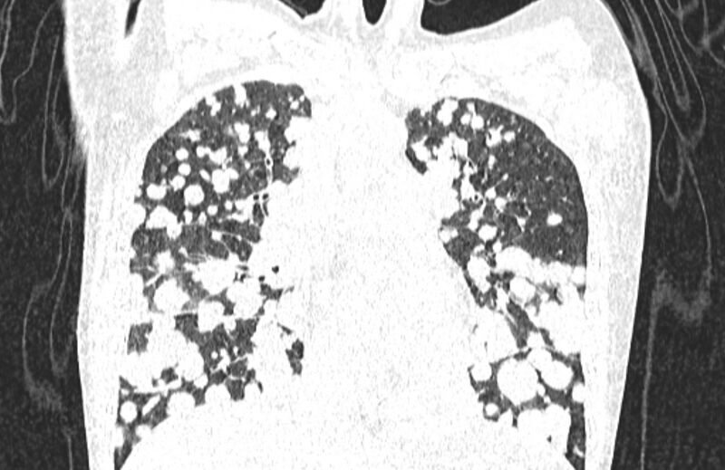 File:Cannonball metastases from breast cancer (Radiopaedia 91024-108569 Coronal lung window 63).jpg