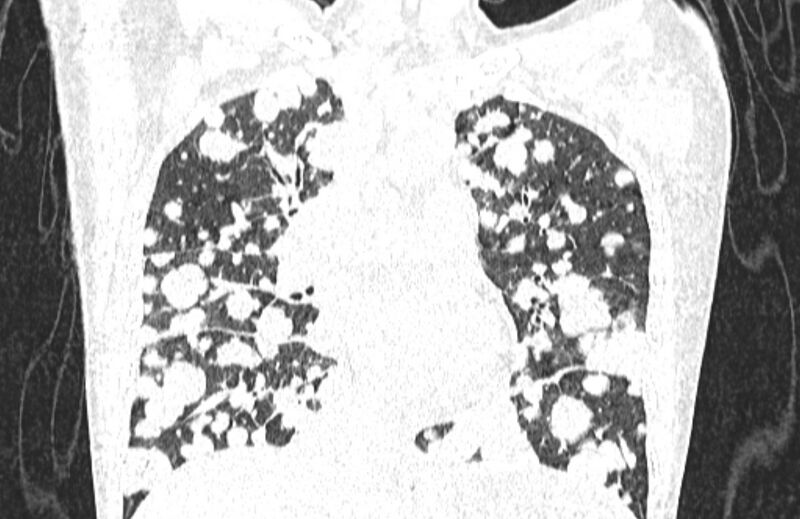 File:Cannonball metastases from breast cancer (Radiopaedia 91024-108569 Coronal lung window 67).jpg