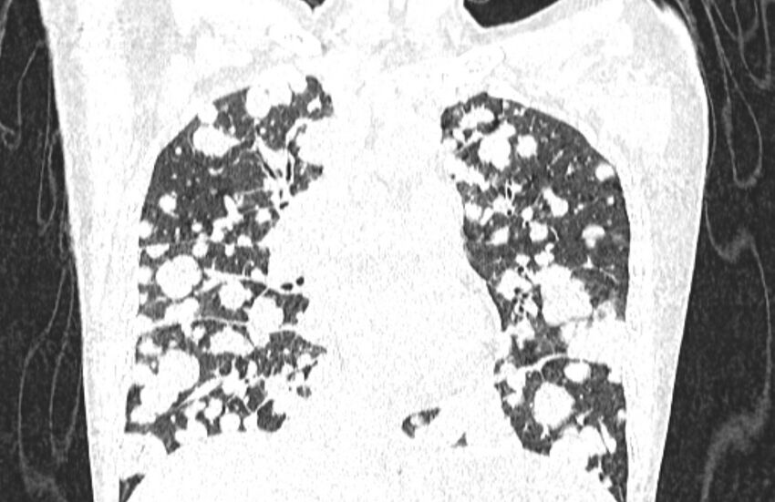 Cannonball metastases from breast cancer (Radiopaedia 91024-108569 Coronal lung window 67).jpg