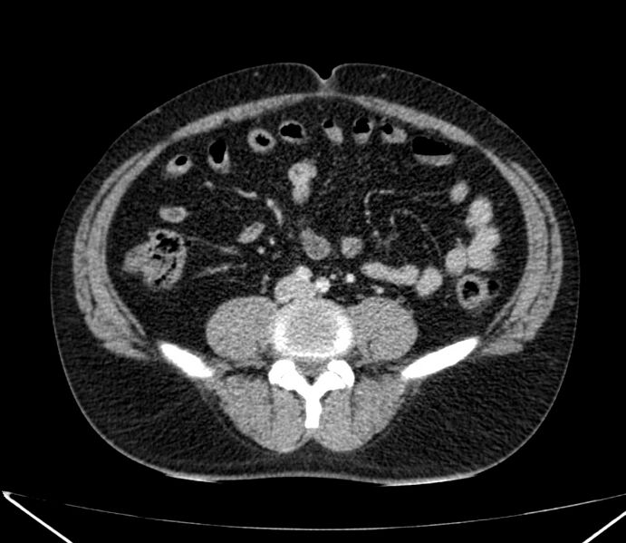 File:Carcinoid tumor with hepatic metastases (Radiopaedia 22651-22670 C 56).jpg