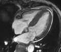 Cardiac amyloidosis (Radiopaedia 39736-42124 D 3).jpg