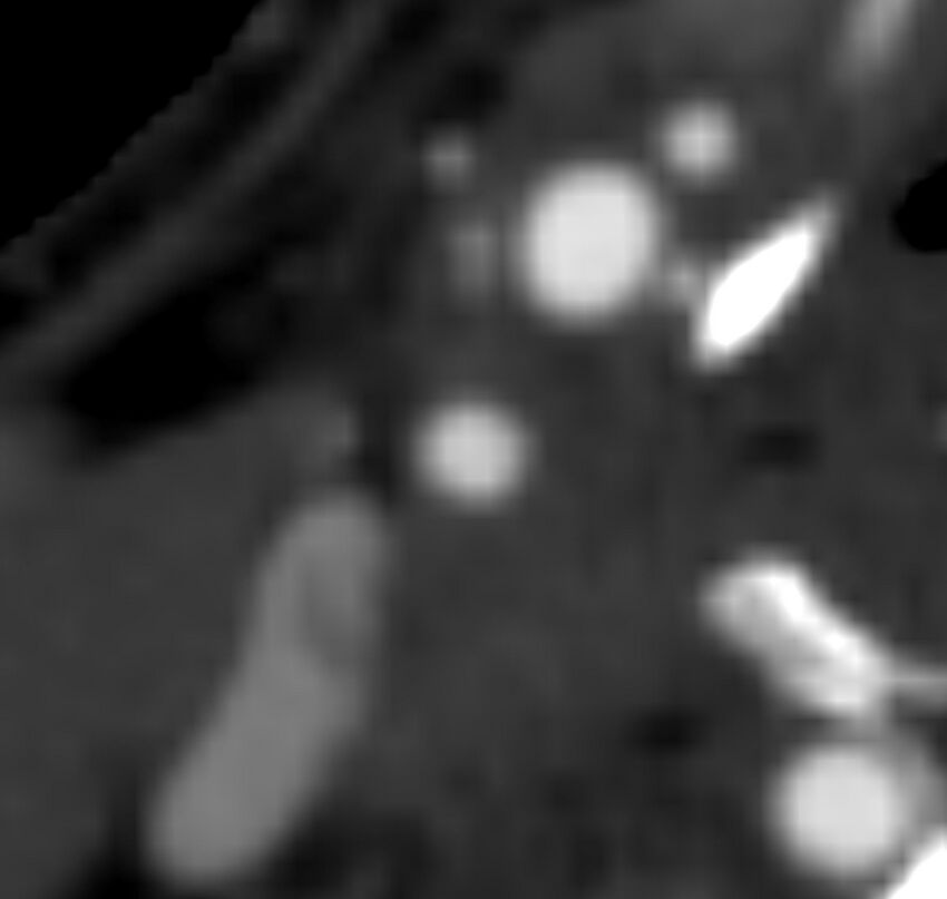 Carotid near-occlusion (Radiopaedia 85304-100887 M 68).jpg
