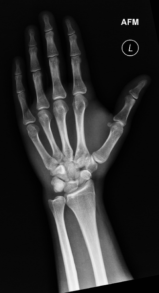 File:Carpal fractures - smart watch impaction (Radiopaedia 55844-62429 Frontal 1).png