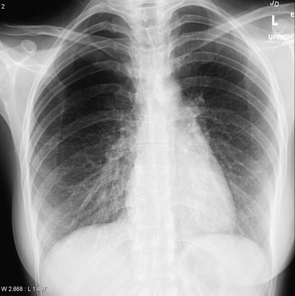 File:Catamenial pneumothorax (Radiopaedia 24847-25112 B 1).jpg