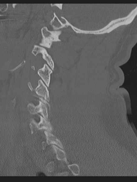 File:Cavernoma of cervical cord (Radiopaedia 50838-56346 Sagittal bone window 56).png
