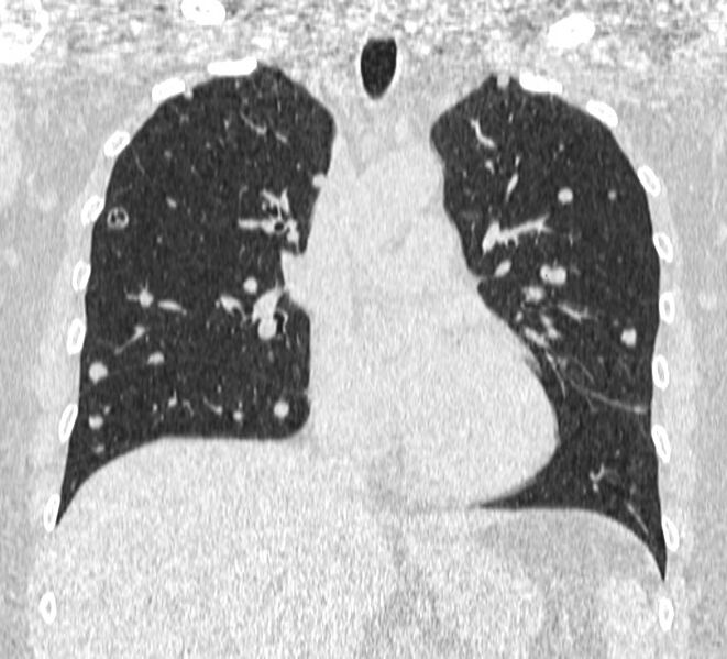 File:Cavitating pulmonary metastases (Radiopaedia 17796-17555 Coronal lung window 10).jpg