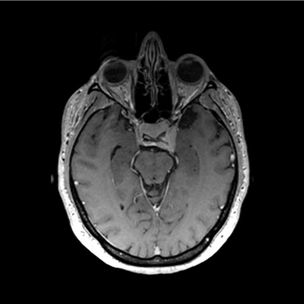 File:Central base of skull meningioma (Radiopaedia 53531-59549 Axial T1 C+ 22).jpg
