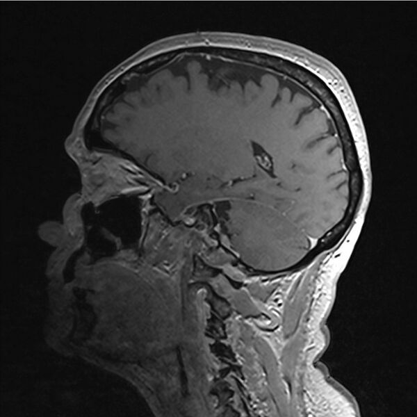 File:Central base of skull meningioma (Radiopaedia 53531-59549 Sagittal T1 C+ 3).jpg