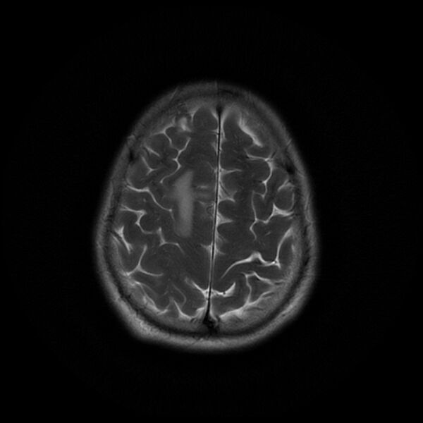 File:Central neurocytoma (Radiopaedia 67618-77021 Axial T2 21).jpg