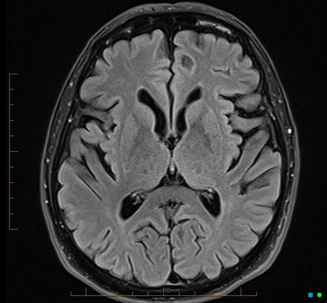 File:Cerebellar gangliocytoma (Radiopaedia 65377-74422 Axial FLAIR 20).jpg