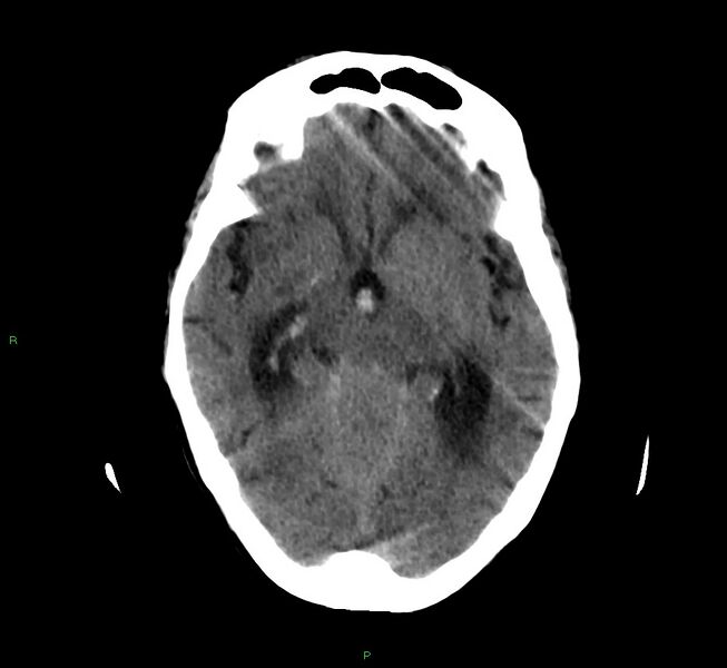 File:Cerebellar hemorrhage (Radiopaedia 58792-66026 Axial non-contrast 30).jpg