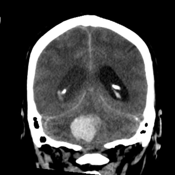 File:Cerebellar hemorrhage causing obstructive hydrocephalus (Radiopaedia 33989-35207 Coronal non-contrast 38).jpg