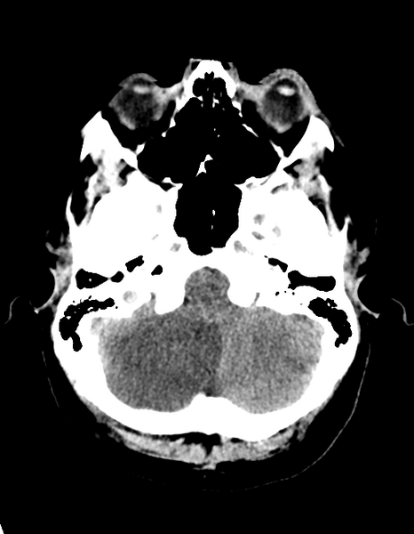 File:Cerebellar infarct due to vertebral artery dissection with posterior fossa decompression (Radiopaedia 82779-97030 Axial non-contrast 8).png
