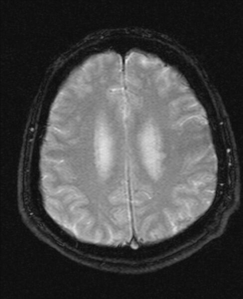 File:Cerebellopontine angle meningioma (Radiopaedia 24459-24764 Axial Gradient Echo 17).jpg