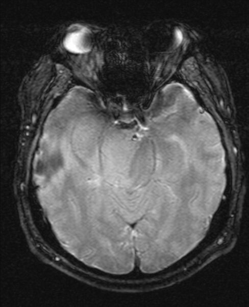 File:Cerebellopontine angle meningioma (Radiopaedia 24459-24764 Axial Gradient Echo 8).jpg