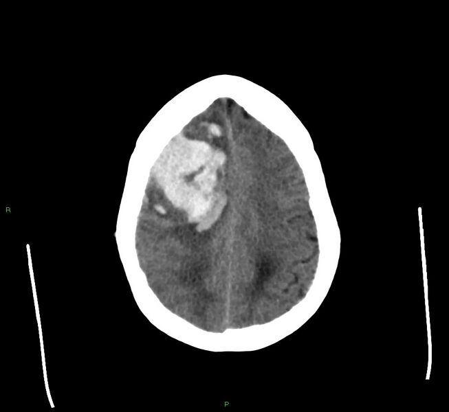 File:Cerebral amyloid angiopathy-associated lobar intracerebral hemorrhage (Radiopaedia 58560-65723 Axial non-contrast 14).jpg