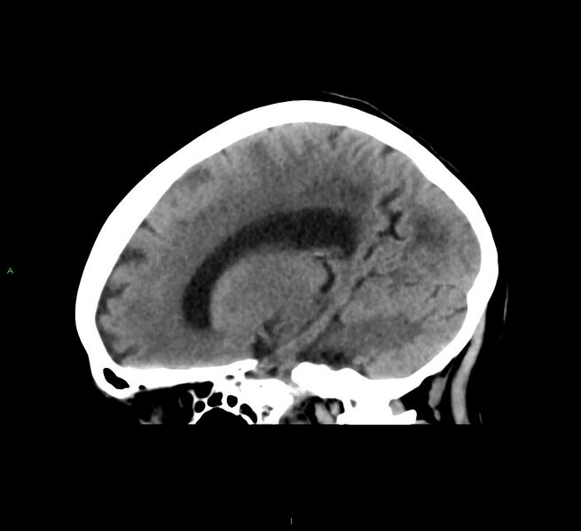 File:Cerebral amyloid angiopathy-associated lobar intracerebral hemorrhage (Radiopaedia 58563-65727 C 33).jpg