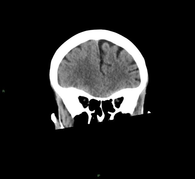 File:Cerebral amyloid angiopathy-associated lobar intracerebral hemorrhage (Radiopaedia 58563-65727 Coronal non-contrast 49).jpg