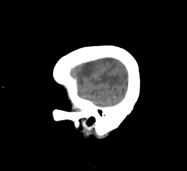 File:Cerebral amyloid angiopathy-associated lobar intracerebral hemorrhage (Radiopaedia 58751-65972 C 9).jpg