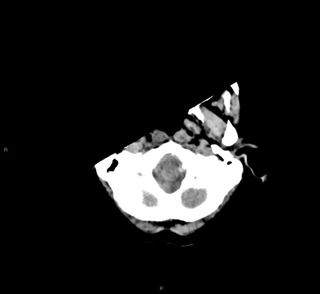 File:Cerebral amyloid angiopathy-associated lobar intracerebral hemorrhage (Radiopaedia 58754-65975 Axial non-contrast 53).jpg