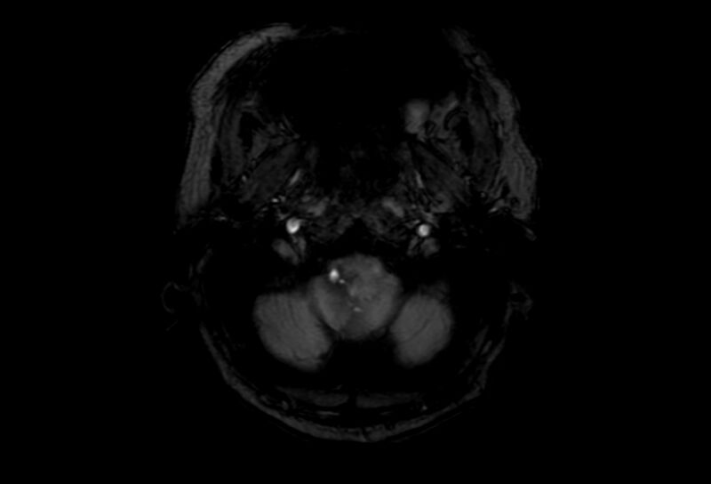 File:Cerebral amyloid angiopathy (Radiopaedia 86671-102792 Axial Gradient Echo 53).jpg