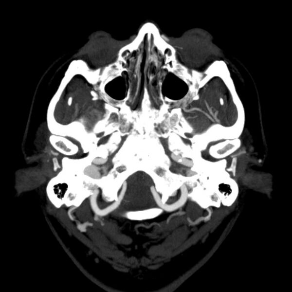 File:Cerebral arteriovenous malformation (Radiopaedia 43729-47189 B 4).jpg